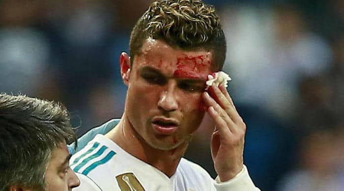 You are currently viewing Watch: Real Madrid treat Ronaldo’s head wound